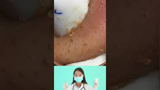 How to extract a blackhead, acne.