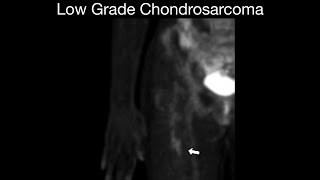 Low Grade Chondrosarcoma