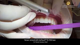 Veneer removal with LiteTouch™ Er:YAG laser