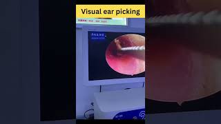 Visual ear picking #shorts #earpicking #earwax #earwaxremoval #amazing #satisfyingvideo #visual #fun