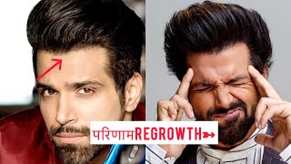 Rithvik Dhanjani| Hair transplant| Results| Minoxidil| Finasteride| hair fall| hindi| hairstyle