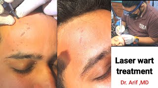 Laser wart removal @Dr Arif, MD (Dermatologist) #warts #warttreatment #laserwarttreatment