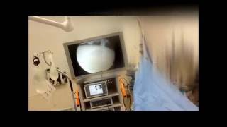 Live Ankle Arthroscopy with an OCD - In the operating room