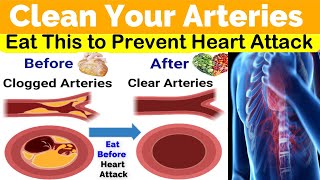 Top Foods Items to Unclog Clogged Arteries Faster & Prevent Heart Attack