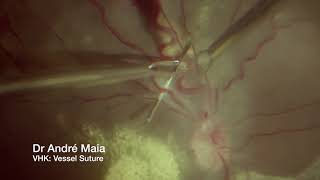 Vessel suture with the Proveo 8 Ophthalmic Microscope | André Maia, MD