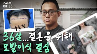 저 모발이식으로 탈모 탈출 가능한가요? 모발이식 상담 브이로그