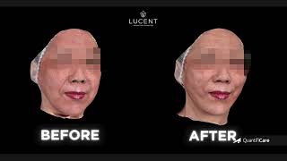 Before After dari Treatment Lucent Lux Thread dari salah satu #Lucentfriends 🤗💕