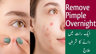 Remove Pimples Overnight | Instant Acne | Glowing Skin | Home Remedy For Acne | Spice and Glamour