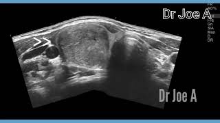 Thyroid adenoma right lobe or colloid nodule ultrasound and color Doppler video