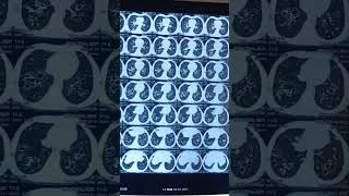 Brochiectasis | bilateral bronchiectasis | bronchiolar dialatation #hrct #ctscan #chest #shorts