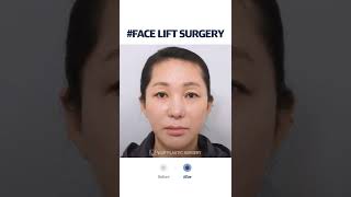 [B&A] Face Lift in Korea Plastic Surgery #shorts