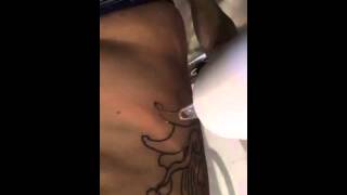 ND YAG Laser Tattoo Removal2