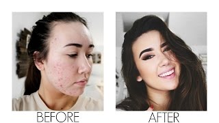 Acne Coverage Foundation Routine // Lindley Edwards