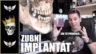 Jak proběhlo zavedení zubního implantátu | MDM doporučuje DOLIDENT