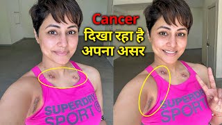 बाप रे 😨 Hina Khan के शरीर पर पड़े खतरनाक निशान | Hina Khan Scars during Breast Cancer Treatment