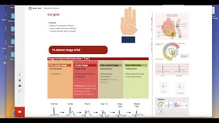 ECG changes in Myocardial Infarction MI