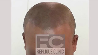 Aaron Gets Scalp Micropigmentation at the Replique Clinic in Brisbane