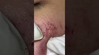 Big Cystic Acne Blackheads Extraction Blackheads & Milia, Whiteheads Removal Pimple Popping