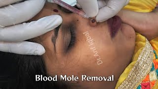 Blood Mole Removal (Nose) By Laser @DrArifMDDermatologist #mole #skin #molesurgery