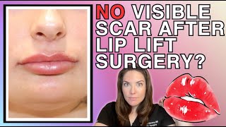 The Invisible Lip Lift Scar Trick They Don't Want You to Know