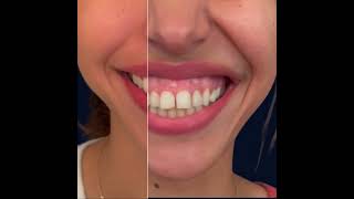 Gummy smile botox #avantaprès #gummysmile #botox