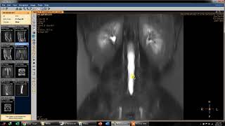 Lumbar Spine MRI (Disc Pathology)