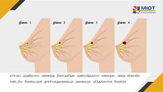 Breast Self Examination in Tamil