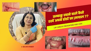 तम्बाकू खाने वाले कैसे रखें अपने होठों का ख़याल ?? Lip cancer prevention and care..