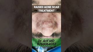 Raised acne scar treatment- steroid injection & CO2 Laser @DrArifMDDermatologist #acnescars