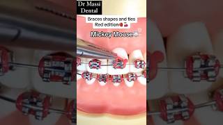 BRACES Decoration types , Orthodontics