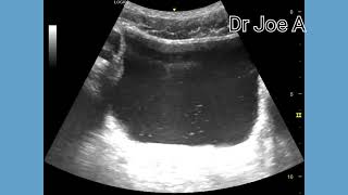 Particles in urinary bladder, ultrasound video