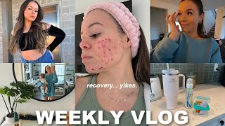 WEEKLY VLOG! work from home mom, intense acne laser, testing viral dupes + more!