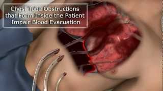 How to Prevent Chest Tube Occlusion - PleuraFlow ACT