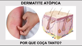 Por que a DERMATITE ATÓPICA coça tanto? Por Luiz Gameiro, médico dermatologista