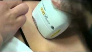 Laser Hair Removal, Intense Pulsed Light, Long Beach, (877)