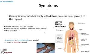 11 Hyperthyroidism