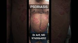 Psoriasis @DrArifMDDermatologist #psoriasis #psoriasistreatment