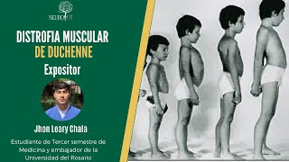 Distrofia Muscular de Duchenne