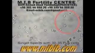 single sperm with 30-35 pus cellsvideo