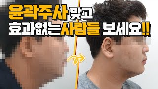 팻버닝시리즈 7탄. 윤곽주사 맞고 효과없었던 분들 보세요.