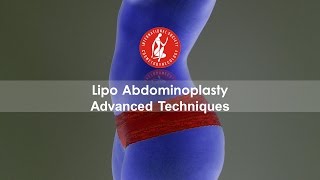 Lipo Abdominoplasty Advanced Techniques