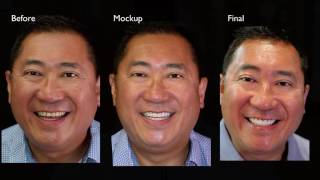 Same Day  Smile Transformation with Dr. Daniel Vasquez.