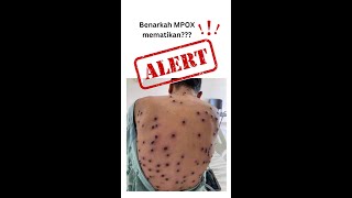 Benarkah MPOX mematikan????