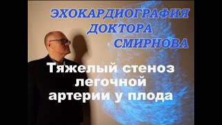 Стеноз легочной артерии у плода, изолированная форма.