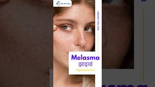 Melasma treatment @Designerdoctor #melasmatreatment #melasma #skin #dermatology