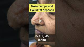 NOSE BUMPS & EYELID FAT DEPOSITS @DrArifMDDermatologist