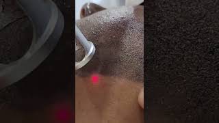 #skinbrightening #skinlightening #lasertreatment #ytshorts #trendingshorts