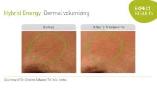 Hybrid Energy Technology for Natural Dermal Refilling and Reducing Wrinkles