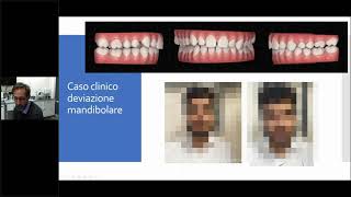 Invisalign deviazione mandibolare