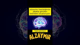 Alzheimer hastalığının tipik belirtileri!  #shortsvideo